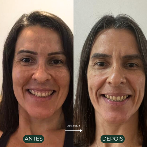 Combo Óleo de Avocado Ozonizado - 5 unidades