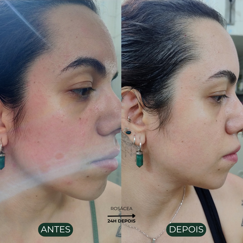 Combo Óleo de Avocado Ozonizado - 5 unidades