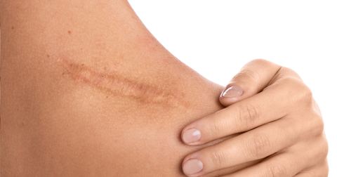 Queloide vs. Cicatriz Hipertrófica: Qual a Diferença e Qual a Rotina de Cuidados Indicada?