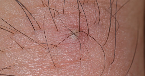 Pelo Encravado: Dicas de Esfoliação e Hidratação para uma Pele Mais Lisa e Sem Bolinhas