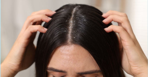 Couro Cabeludo Sensível e com Caspa: A rotina de cuidados para aliviar a coceira e a descamação