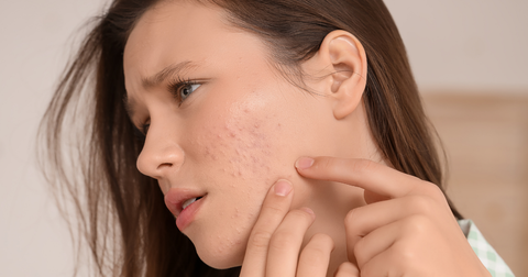 Espinhas no Queixo e Maxilar: O Que a Acne Hormonal Sinaliza e Como Cuidar